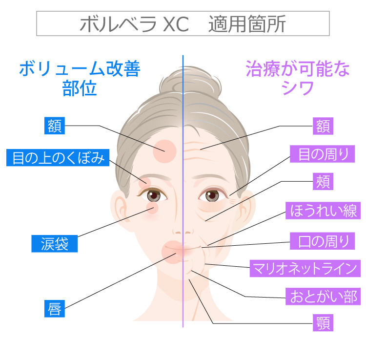 新世代型ヒアルロン酸ジュビダームビスタ | 美容整形はTCB東京中央美容外科