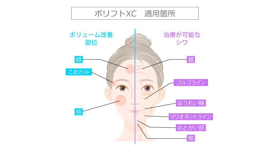 新世代型ヒアルロン酸ジュビダームビスタ | 美容整形はTCB東京中央美容外科