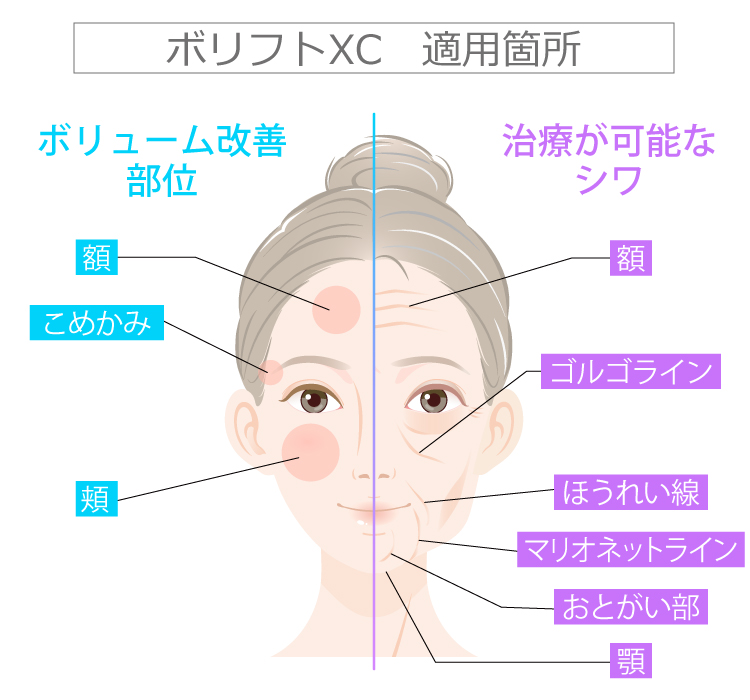 新世代型ヒアルロン酸ジュビダームビスタ | 美容整形はTCB東京中央美容外科