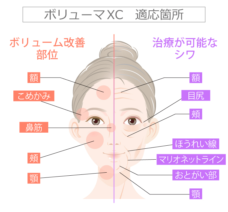 新世代型ヒアルロン酸ジュビダームビスタ | 美容整形はTCB東京中央美容外科
