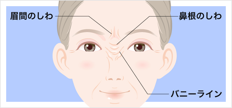 プチ整形 眉間のしわ治療 ボトックス ヒアルロン酸注射 美容整形なら東京中央美容外科 Tcb公式