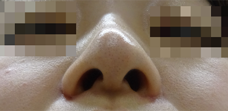 【脂肪溶解注射】鼻Case1_AFTER
