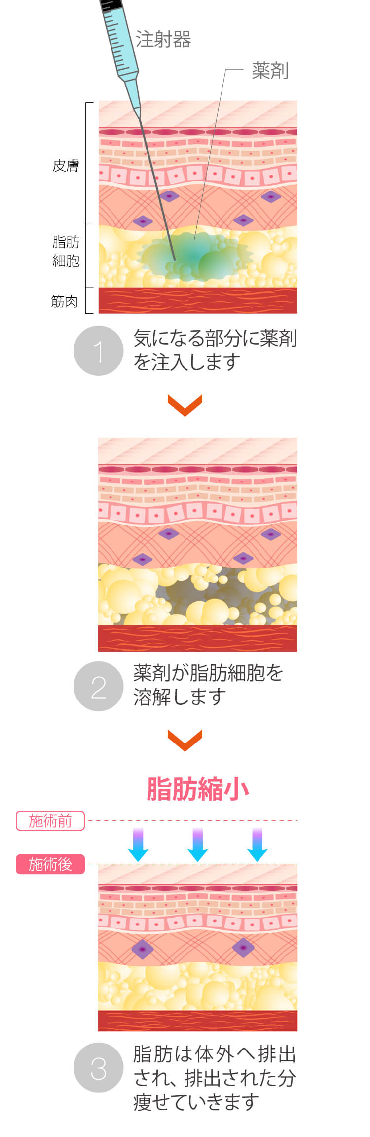 顔痩せクリニックの1day小顔ダイエット注射 美容整形なら東京中央美容外科 Tcb公式