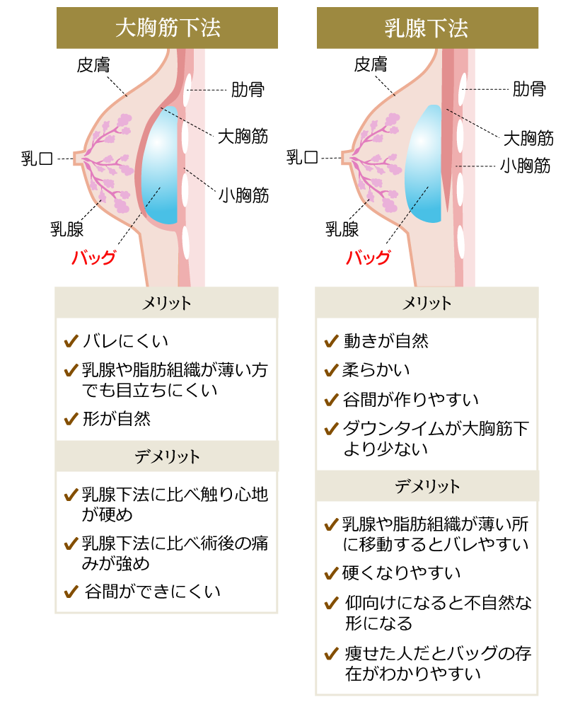 大胸筋下法のメリットは、バレにくく、乳腺や脂肪組織が薄い方でも目立ちにくく、形が自然です。デメリットは、乳腺下法に比べ触り心地が硬めで、乳腺下法に比べ術後の痛みが強めで、谷間が動きにくいのが特徴です。乳腺下法のメリットは、動きが自然、柔らかい、谷間が作りやすい、ダウンタイムが大胸筋下法より少ない。デメリットは、乳腺や脂肪組織が薄い方に移動するとバレやすい、硬くなりやすい、仰向けになると不自然な形になる、痩せた人だとバッグの存在がバレやすいのが特徴です。