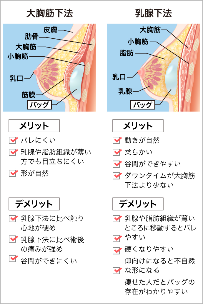 たった1時間 憧れのふっくらマシュマロバストになれるバッグ豊胸術 美容整形なら東京中央美容外科 Tcb公式