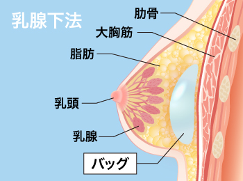 乳腺下法はバストの乳腺の下に挿入します