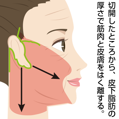 フェイスリフトでは剥離は重要