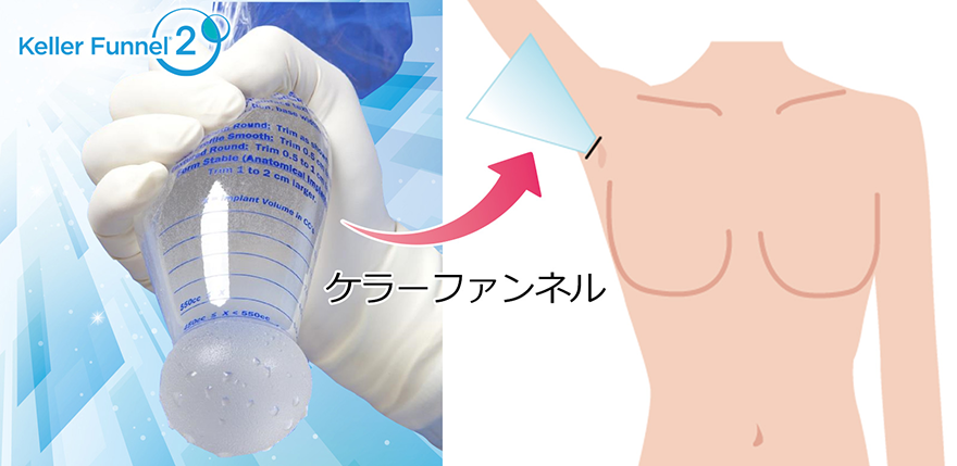 豊胸手術の時間を短縮し、切開口も小さくするケラーファンネル