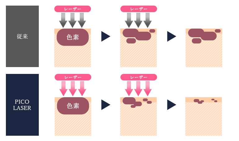 PICO LASERが照射するレーザーは「ピコ秒」という極めて短い波長のもので、周囲の皮膚組織への熱ダメージが少ないのが特徴です。