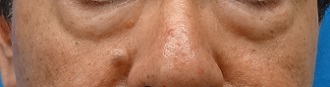 切開法による目の下のたるみ取り（下眼瞼除皺術）-症例写真-ビフォーアフター