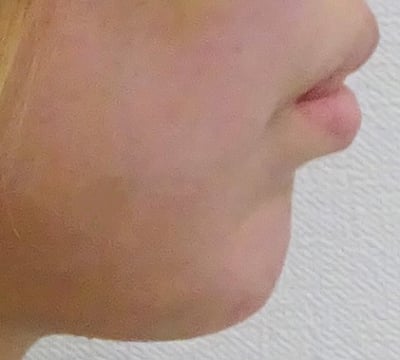 あごのヒアルロン酸注射-症例写真