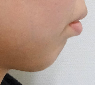 あごのヒアルロン酸注射-症例写真