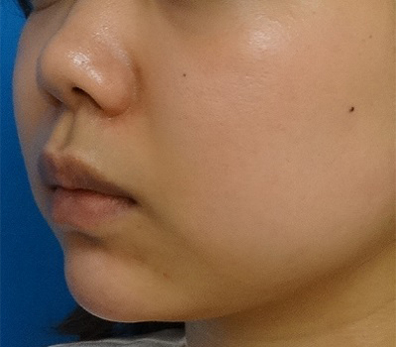 あごのヒアルロン酸注射-症例写真-ビフォーアフター
