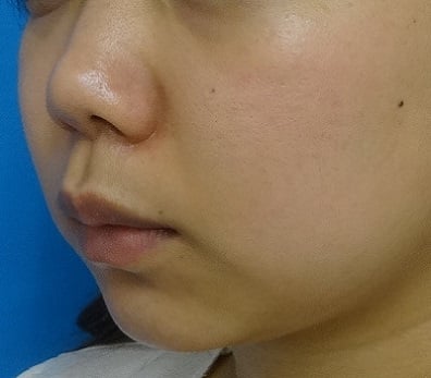 あごのヒアルロン酸注射-症例写真-ビフォーアフター
