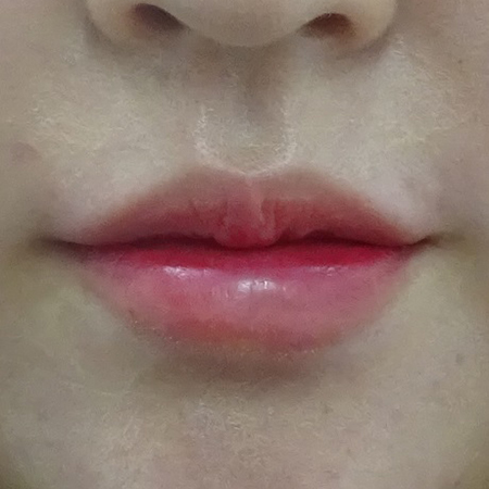 唇のヒアルロン酸注射（アヒル口・厚くする）-症例写真-ビフォーアフター