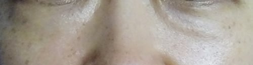 切開法による目の下のたるみ取り（下眼瞼除皺術）-症例写真-ビフォーアフター