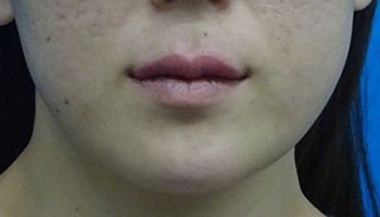 唇のヒアルロン酸注射（アヒル口・厚くする）-症例写真-ビフォーアフター
