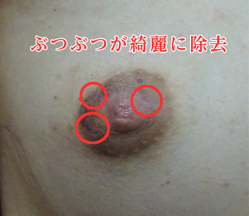 モントゴメリー腺（乳輪のぶつぶつ）の成功例の一部写真アフター01