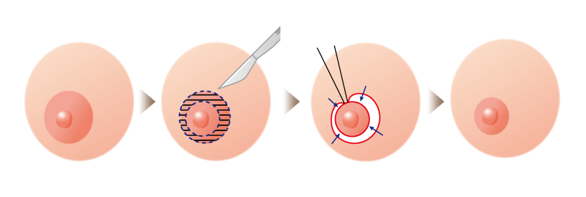 乳輪縮小術の手術方法2外側（乳輪の一番外側）切除法
