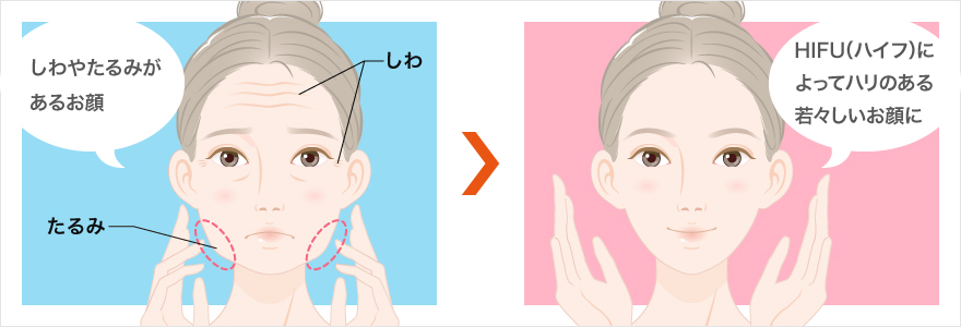 医療用ハイフ ソノクイーン たるみ改善治療 美容整形なら東京中央美容外科 Tcb公式