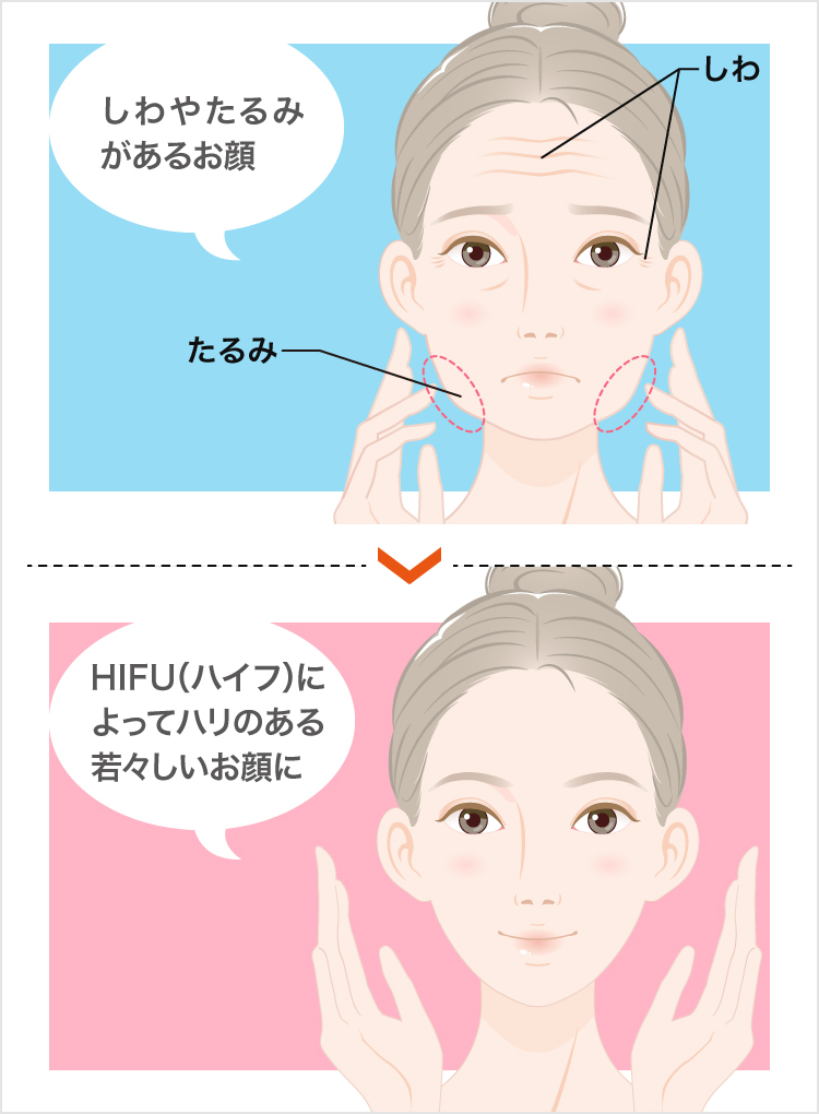 医療用ハイフ ソノクイーン たるみ改善治療 美容整形なら東京中央美容外科 Tcb公式