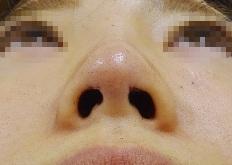 鼻先尖鋭術症例写真02-アフター