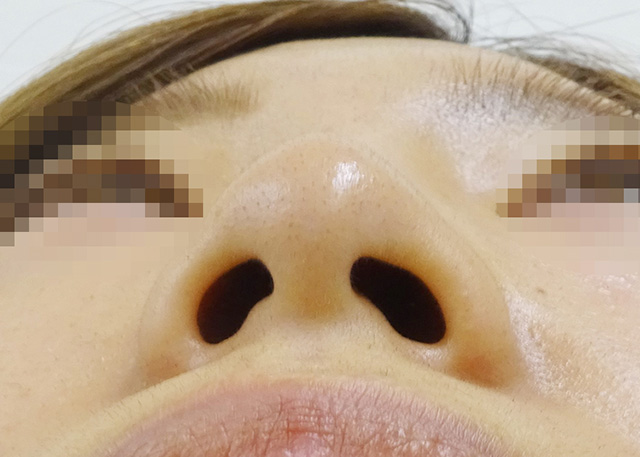 鼻先尖鋭術症例写真02-ビフォー