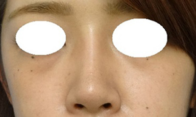 隆鼻術（シリコンプロテーゼ）症例写真5　術後