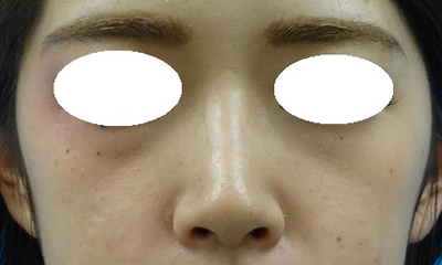 隆鼻術（シリコンプロテーゼ）症例写真5　術前