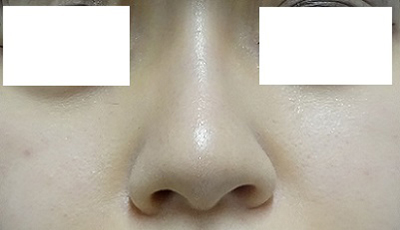 隆鼻術（シリコンプロテーゼ）症例写真4　術後