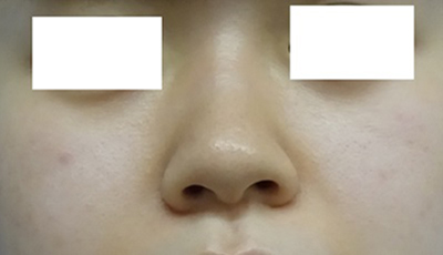隆鼻術（シリコンプロテーゼ）症例写真4　術前