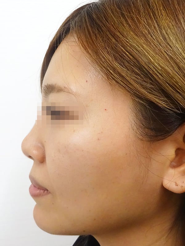 隆鼻術（シリコンプロテーゼ）症例写真1　術前