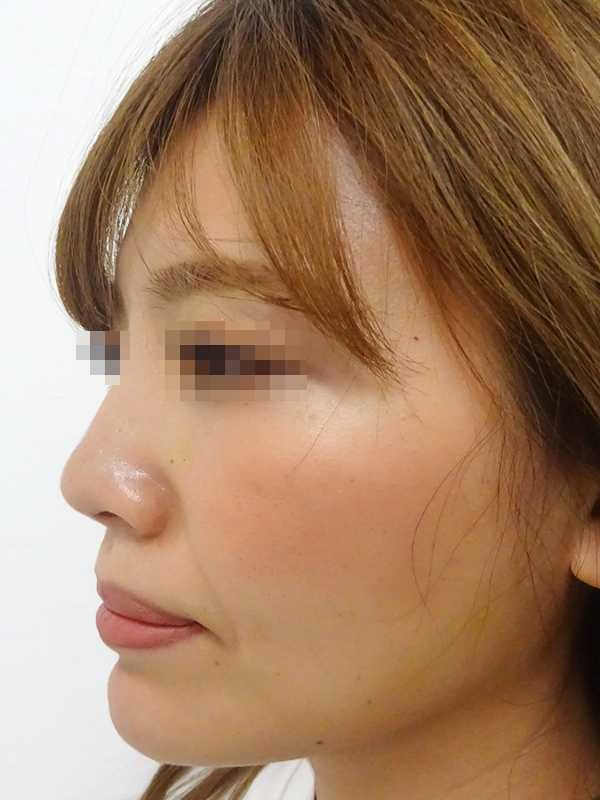 隆鼻術（シリコンプロテーゼ）症例写真1　術後