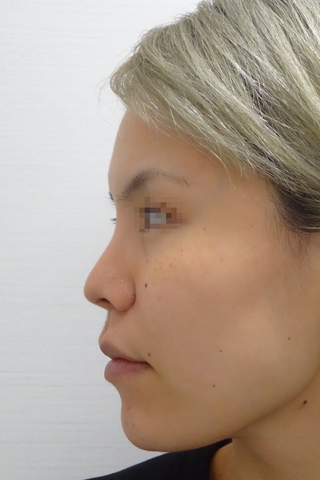 隆鼻術（シリコンプロテーゼ）症例写真2　術後