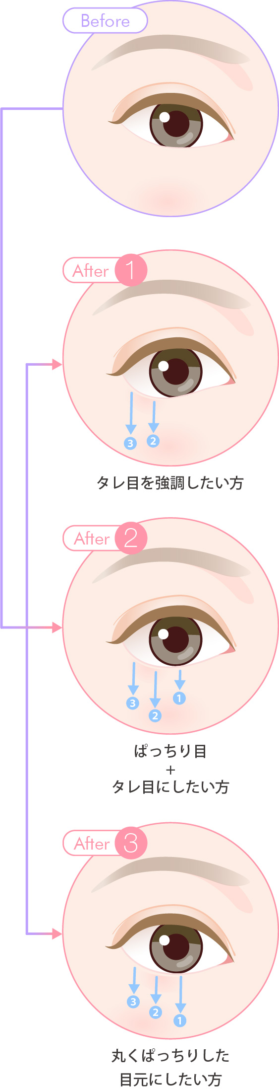 グラマラスライン タレ目形成で優しく癒やされる印象に 美容整形なら東京中央美容外科 Tcb公式