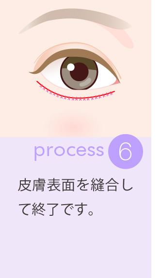 6：皮膚表面を縫合して終了です