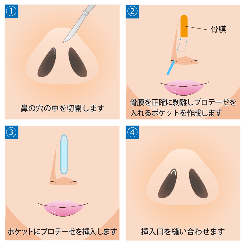 隆鼻術（シリコンプロテーゼ）の手術方法