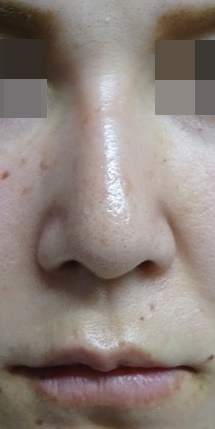 隆鼻術（シリコンプロテーゼ）症例写真3　術後