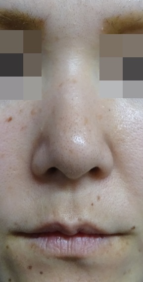 隆鼻術（シリコンプロテーゼ）症例写真3　術前
