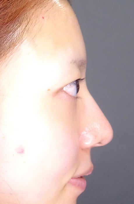 鼻先尖鋭術症例写真01-ビフォー