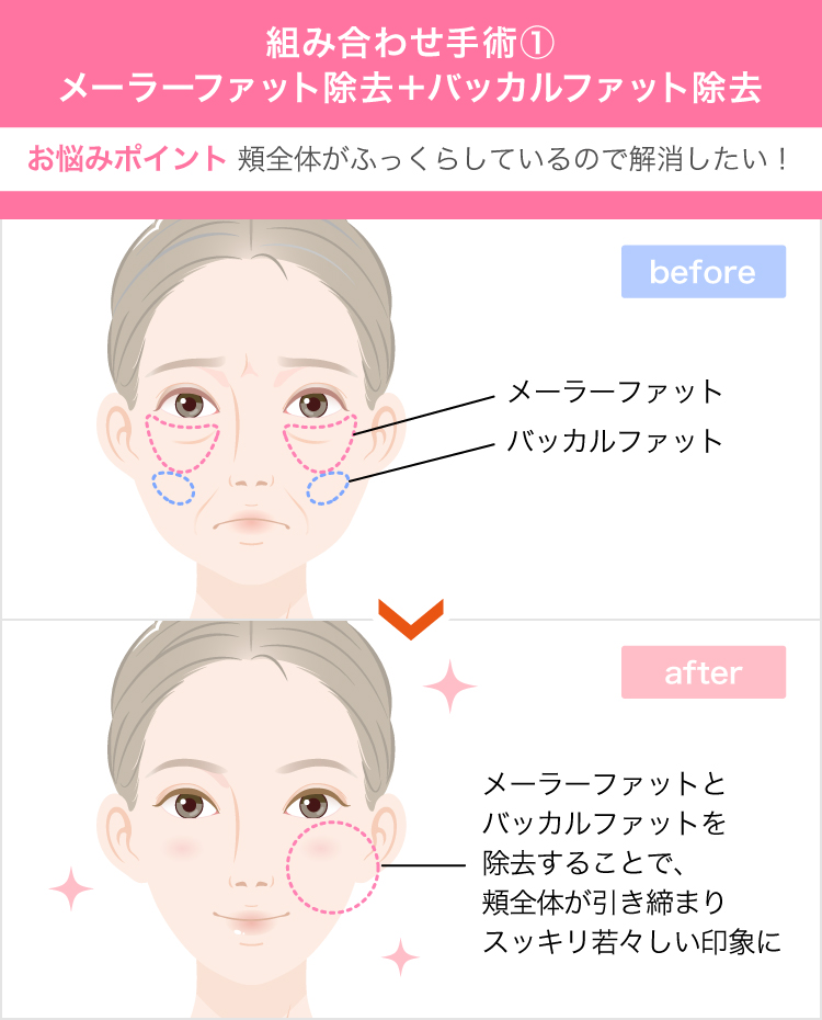 バッカルファットの効果は 頬のたるみ ほうれい線を改善しシャープなモテ系小顔に変身できることです 美容整形なら東京中央美容外科 Tcb公式