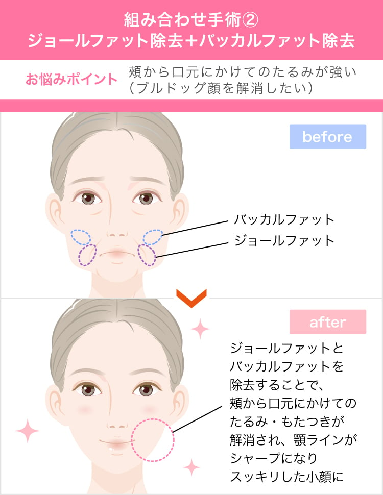バッカルファットの効果は 頬のたるみ ほうれい線を改善しシャープなモテ系小顔に変身できることです 美容整形なら東京中央美容外科 Tcb公式