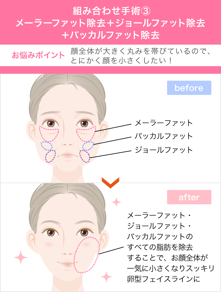 バッカルファットの効果は 頬のたるみ ほうれい線を改善しシャープなモテ系小顔に変身できることです 美容整形なら東京中央美容外科 Tcb公式