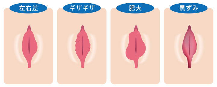 小陰唇縮小手術のお悩みパターン