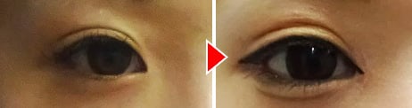目頭切開はのメリットは、ダウンタイムが少なく値段も安価。二重術と合わせることで自分史上最大級の目元に