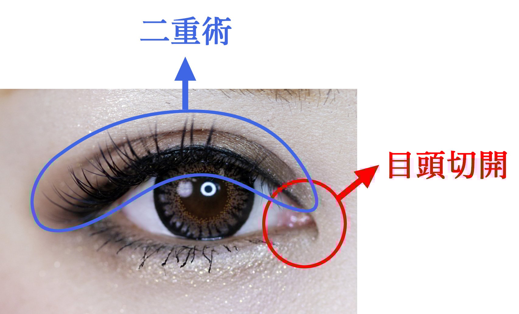 目頭切開と二重術を組み合わせると最大級の目元が実現
