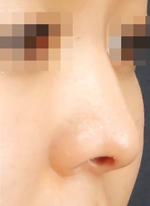 鼻中隔延長-症例写真-ビフォーアフター