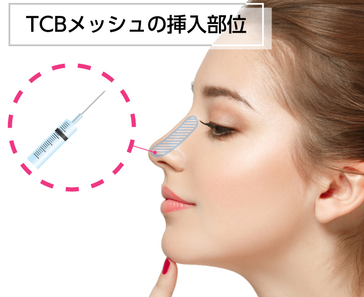 Tcbメッシュ 鼻の高さボリュームアップ 美容整形なら東京中央美容外科 Tcb公式