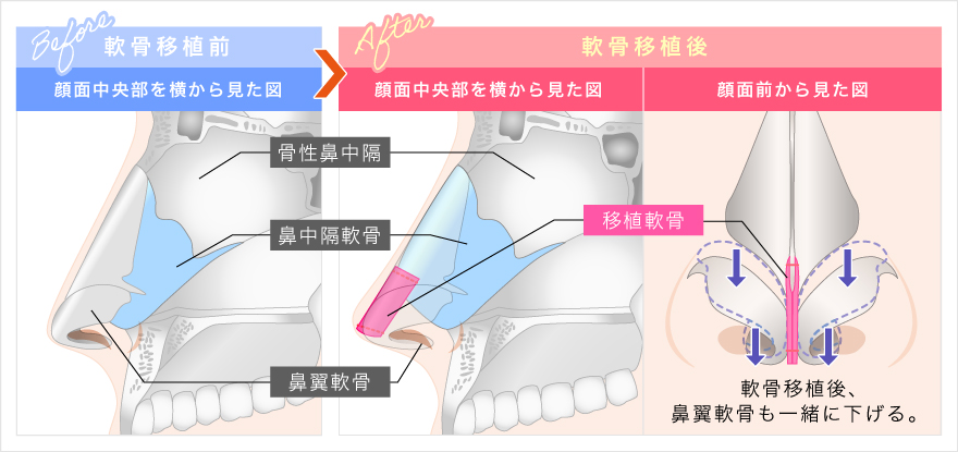 鼻中隔延長術（耳軟骨移植術）の施術方法