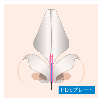 鼻中隔延長での軟骨強化プレート（PDSプレート）について